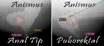 Anismus, Anal Ve Puborektal Tip