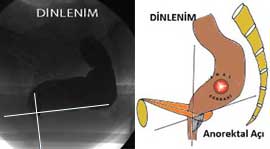 defekografi dinlenim