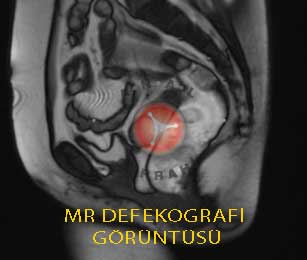 MR Defekografi görüntü